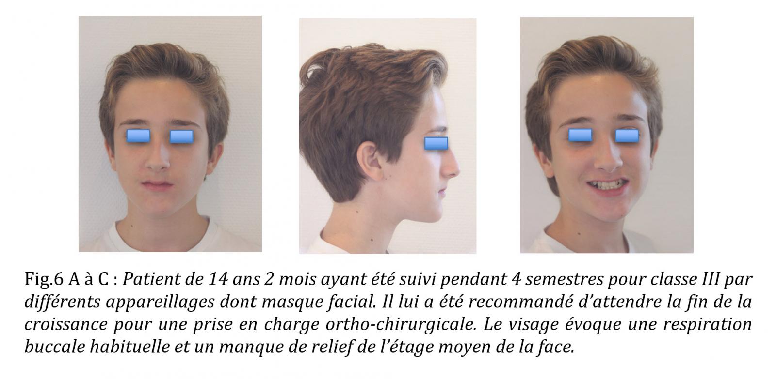 Traitement fonctionnel de l’hypoplasie transversale du maxillaire Innoralis